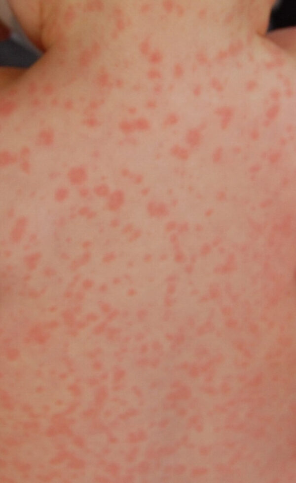 Webbing Rash Oxulate Oxalate Dumping Symptoms - Health & Wellness